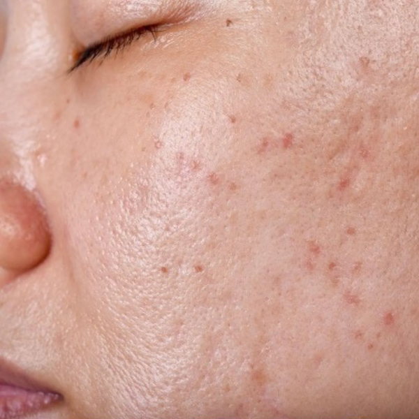 Breakouts
