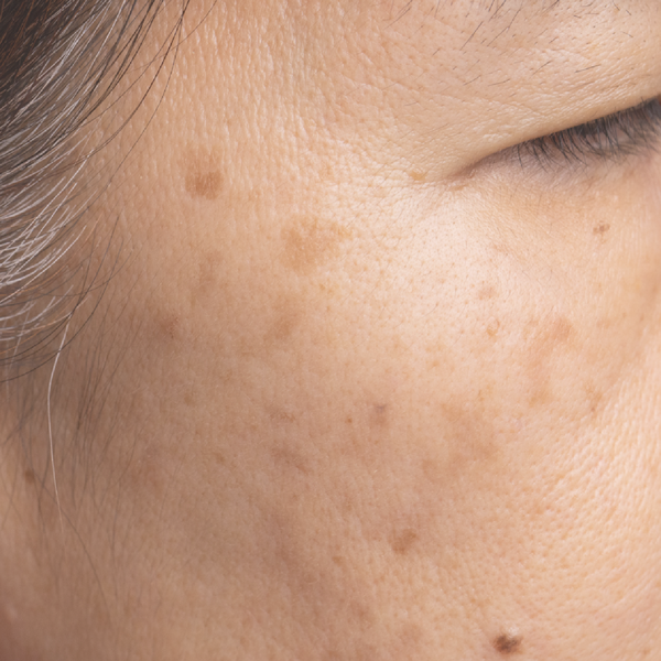 Dark Spots